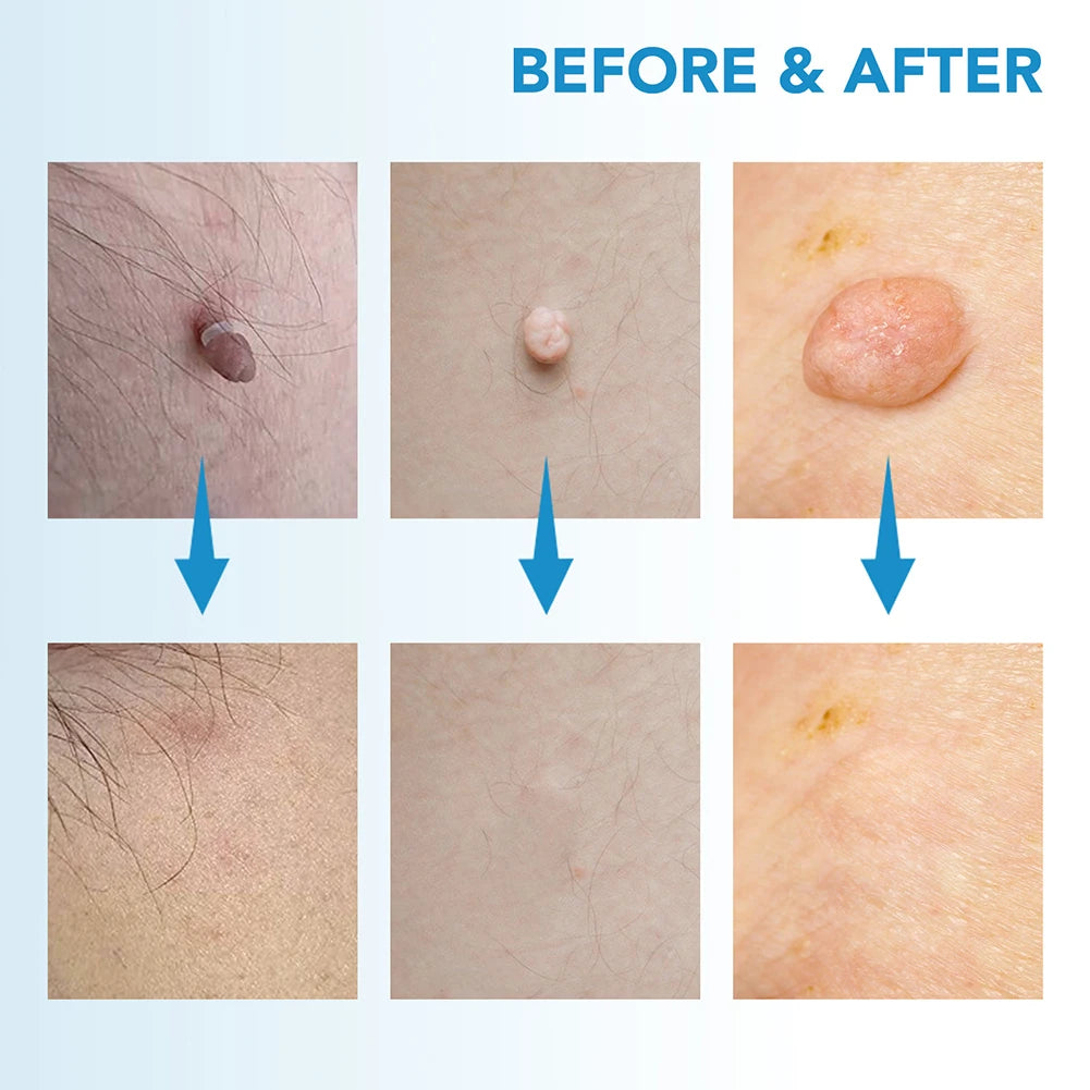 Mole Wart Remover Kit