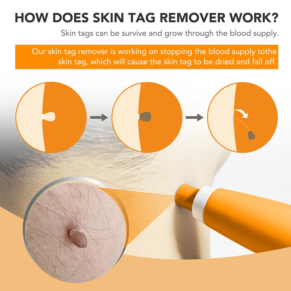 Mole Wart Remover Kit