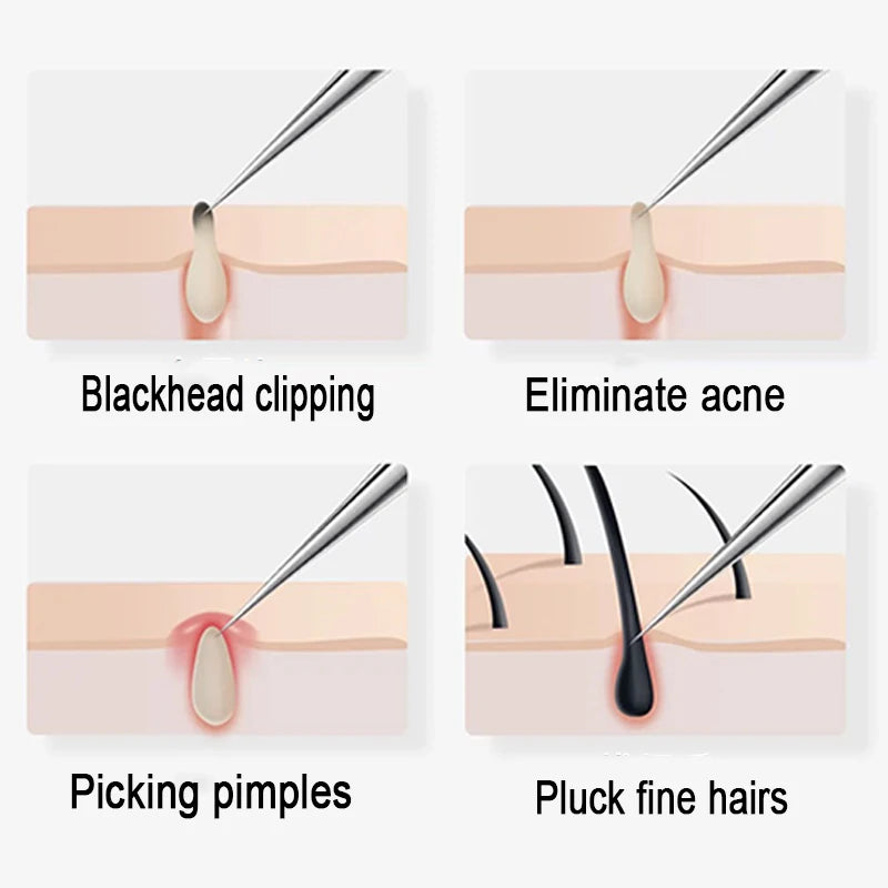 Acne Needle Blackhead Tweezers Removal Tool