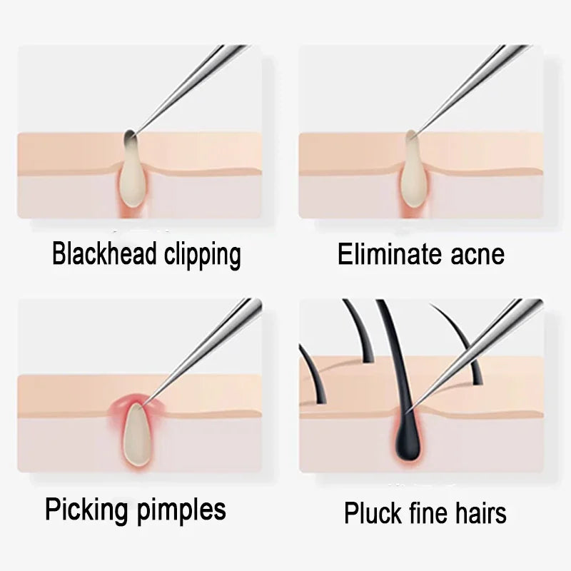 Acne Needle Blackhead Tweezers Removal Tool
